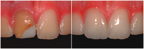 cosmetic dentistry - composite resins
