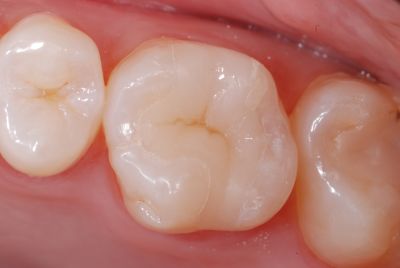 image of tooth after onlay