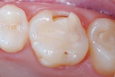 image of tooth before inlays / onlays