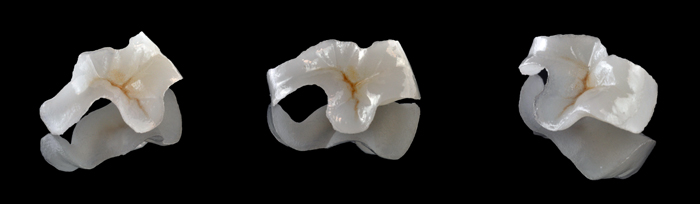 images of onlays