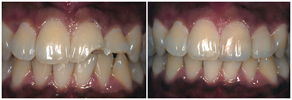 cosmetic dentistry - repair fractures