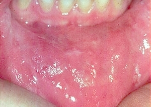 aphthous ulcers