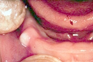 Congenital keratotic cyst