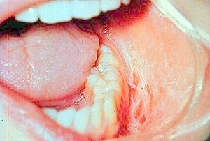 Familial Epithelial Hyperplasia