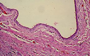 Gingival Cyst of Adult