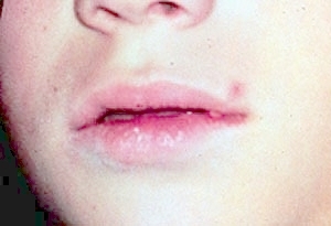 herpes