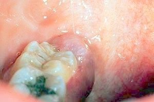 kaposi's sarcoma