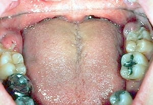 kaposi's sarcoma