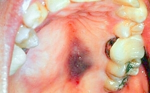 kaposi's sarcoma