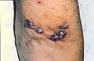 kaposi's sarcoma
