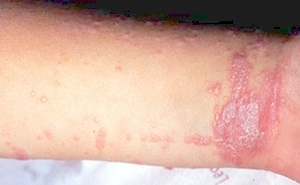 Lichen planus (skin)
