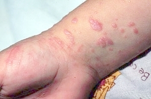 Lichen planus (skin)