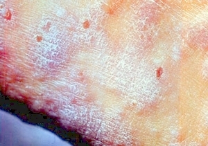 Lichen planus (skin)