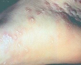 Lichen planus (skin)