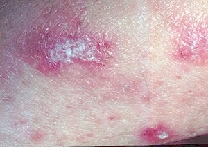 Lichen planus (skin)