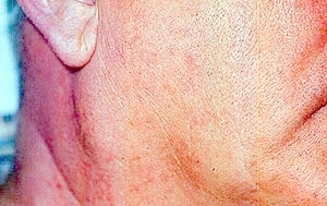 mucoepidermoid carcinoma