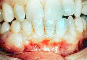 peripheral fibroma
