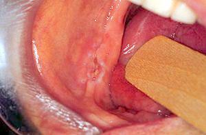 squamous cell carcinoma 