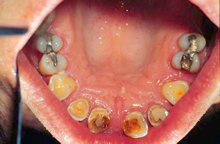 occlusal maxillary