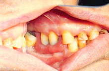 left buccal