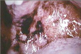 pigmented areas on palate