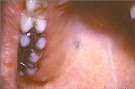 teeth, hard and soft palate on right side
