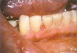 mandibular anterior teeth and gingiva mandibular anterior teeth and gingiva