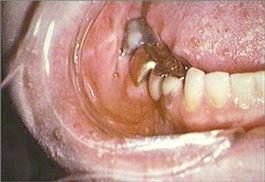 right mandibular teeth and mucobuccal fold right mandibular teeth and mucobuccal fold