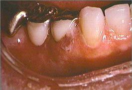 close-up of right mandibular teeth and gingiva close-up of right mandibular teeth and gingiva