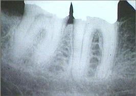 periapical radiograph of mandibular molars 