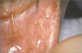 lower left labial vestibule and lip</p>
<p>