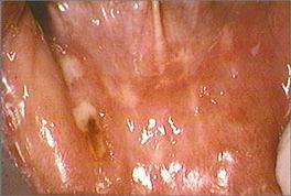lower right labial vestibule and lip with ulcers
