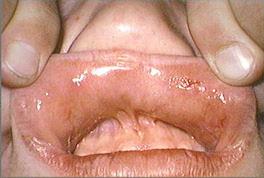 upper labial vestibule and lip