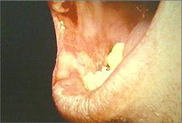 ulcers on the right buccal & labial mucosa