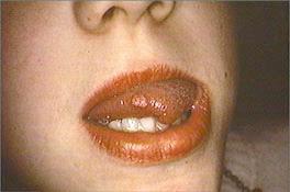 right lateral tongue