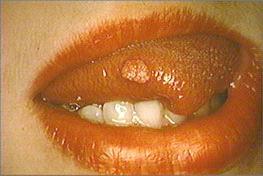 close-up of right lateral tongue