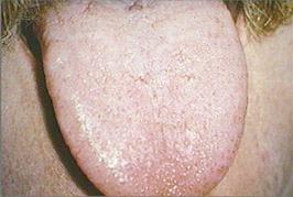 soft tissue enlargement of the tongue