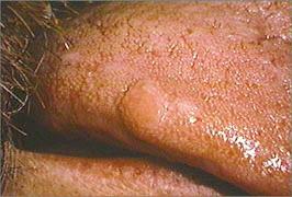 close-up of soft tissue enlargement