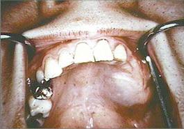 enlargement of palate and alveolar ridge