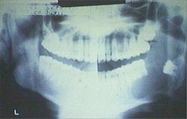 panoramic radiograph