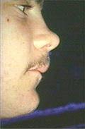 lateral anterior face