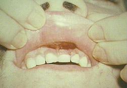 upper lip everted