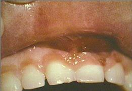 close-up of upper lip everted