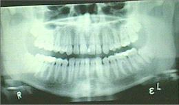 panoramic radiograph
