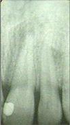 periapical radiograph
