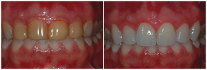 cosmetic dentistry - porcelain restoration