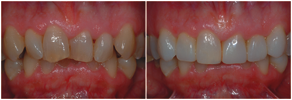 cosmetic dentistry - realign crooked teeth