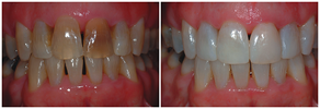 cosmetic dentistry - modify shade