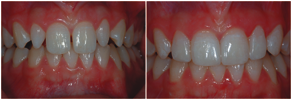 cosmetic dentistry - close spaces